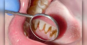 Marked increase in Korea periodontal disease patients | Dental Resource Asia