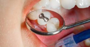 Common stressors significantly increase mercury released from amalgam fillings | Dental Resource Asia