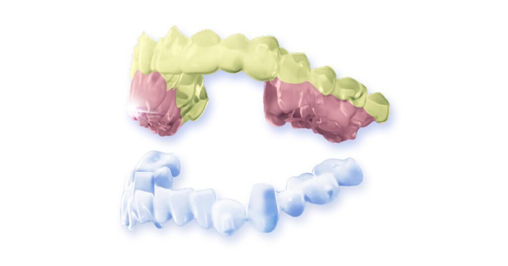 Smartee GS Occlusal Reconstruction Device | Clear aligner orthodontics | China dental news | Dental Resource Asia