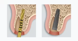 ZimVie announces US launch of TSX Implant | Dental Resource Asia