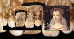 400-year-old dental secret of french aristocrat Anne d'Alegre unveiled_Dental Resource Asia