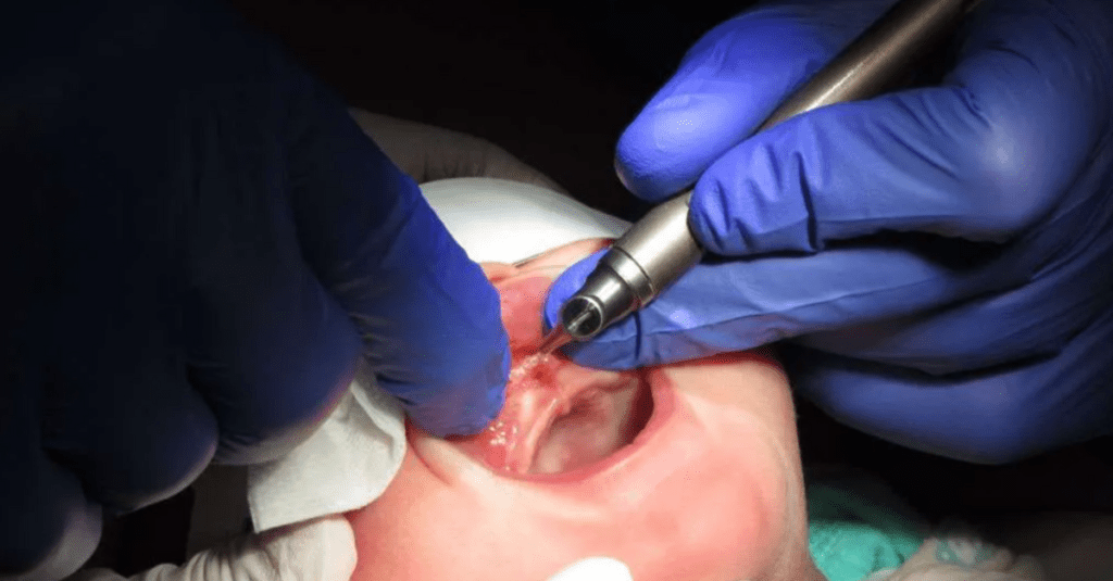 Comprehensive Guide to Laser Dentistry_laser frenectomy_Dental Resource Asia