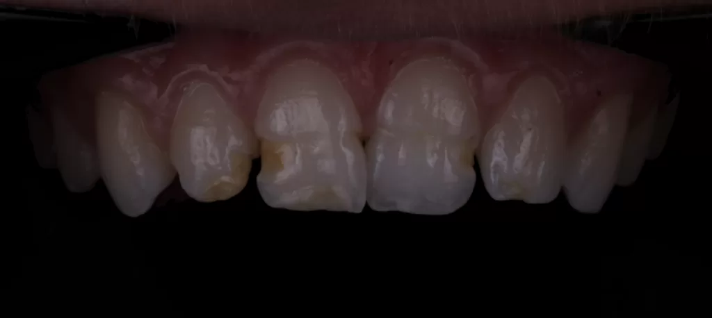 Fig 1_Management of Hypoplasia_Dental Resource Asia