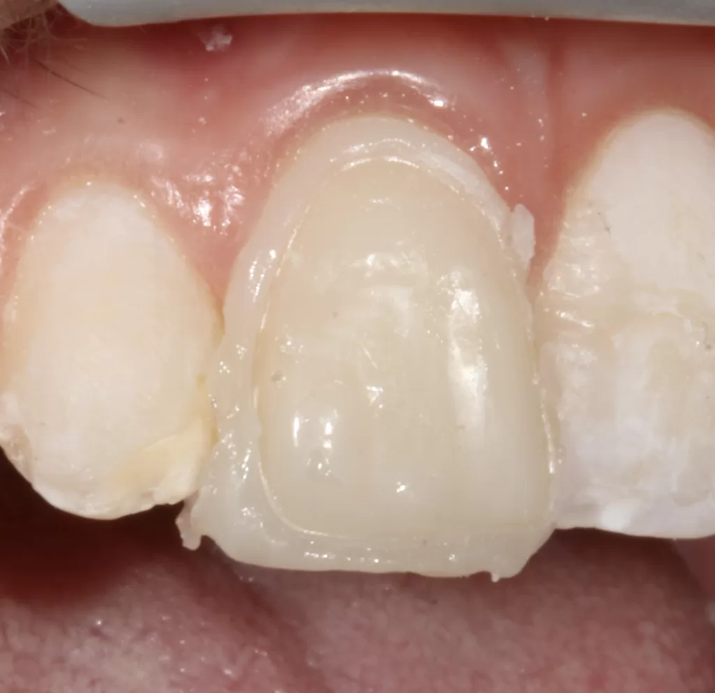 Fig-2_Management of Hypoplasia_Dental Resource Asia