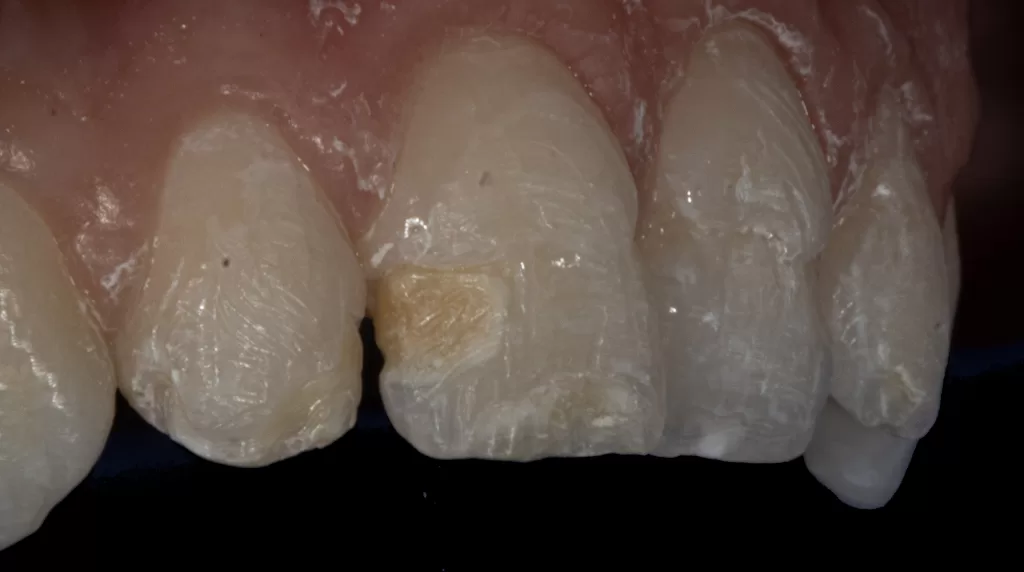 Fig-3_Management of Hypoplasia_Dental Resource Asia