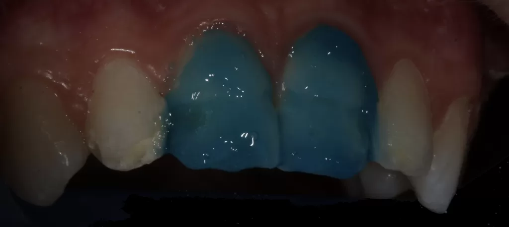 Fig-4a_Management of Hypoplasia_Dental Resource Asia