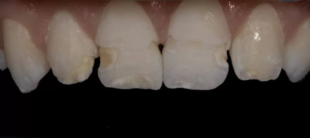 Fig-4b_Management of Hypoplasia_Dental Resource Asia