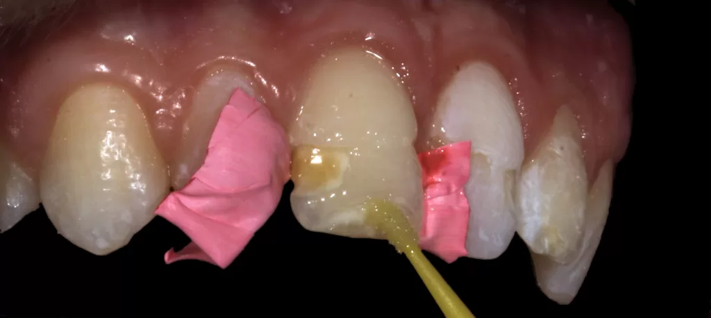 Management of Hypoplasia_Dental Resource Asia