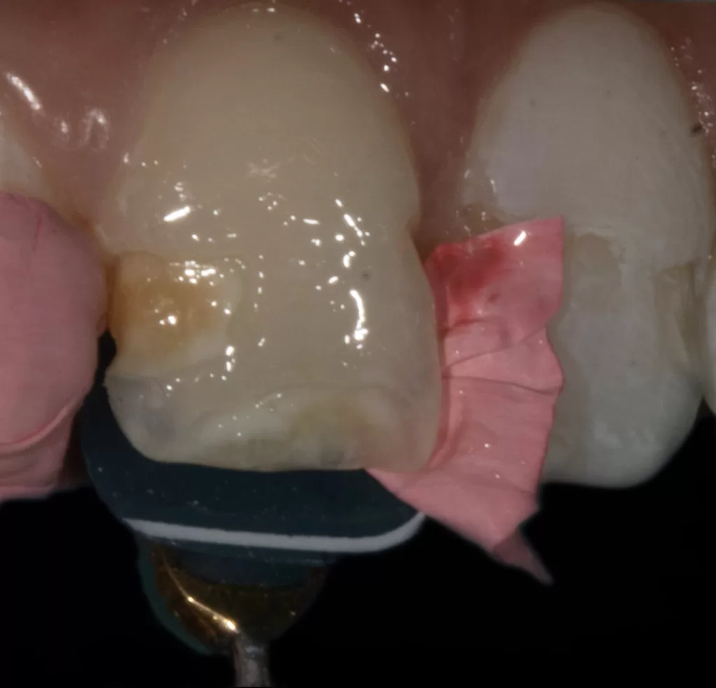 Fig 6b_Management of Hypoplasia_Dental Resource Asia