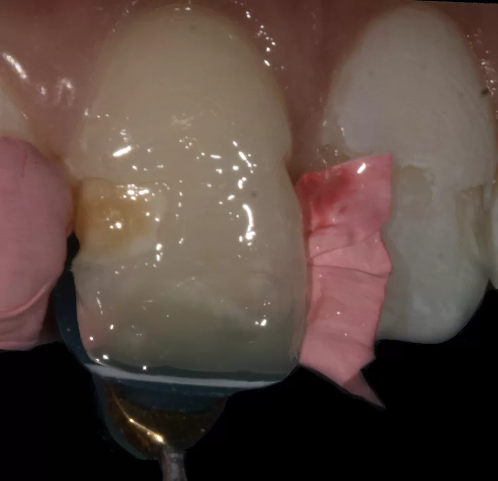 Fig 6c_Management of Hypoplasia_Dental Resource Asia