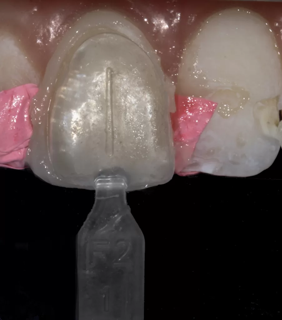 Fig 7b_Management of Hypoplasia_Dental Resource Asia