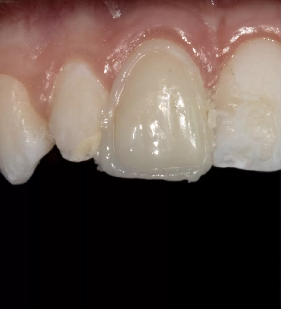 Fig 7c_Management of Hypoplasia_Dental Resource Asia