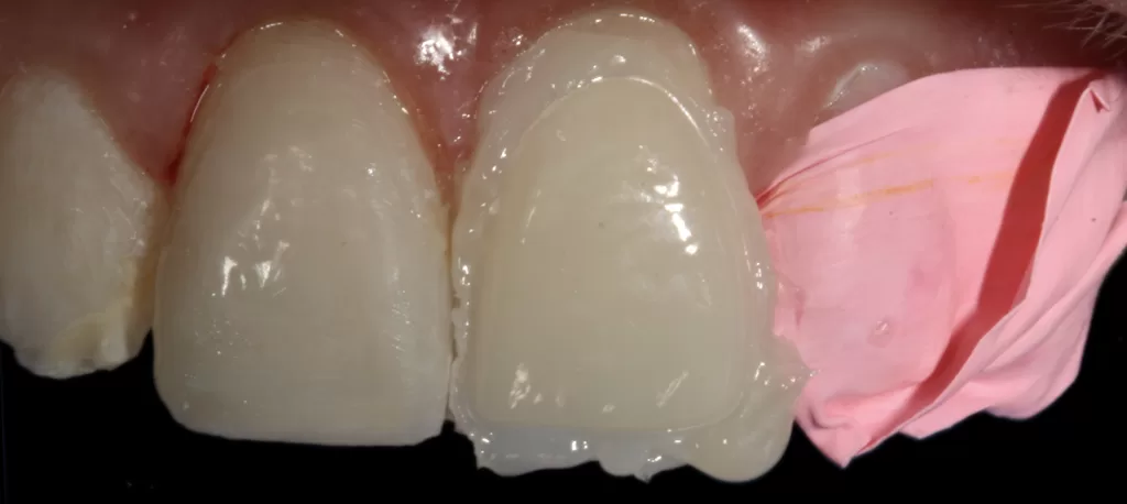 Fig 8c_Management of Hypoplasia_Dental Resource Asia