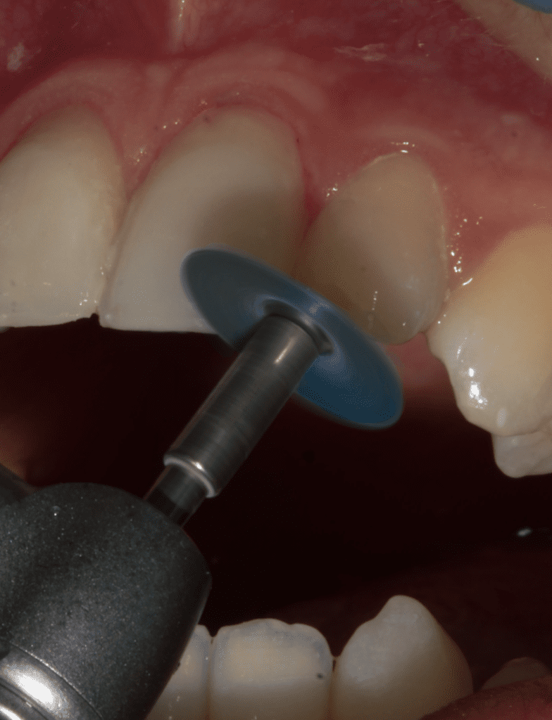 Fig 9b_Management of Hypoplasia_Dental Resource Asia