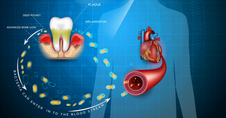 New Consensus Report Confirms Link Between Gum Disease and Systemic Diseases_Dental Resource Asia