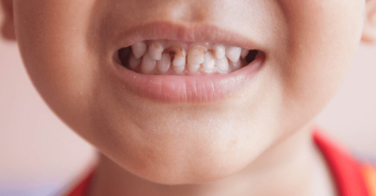 Anemia-Related Dental Caries Impacting Children's Quality of Life_Dental Resource Asia