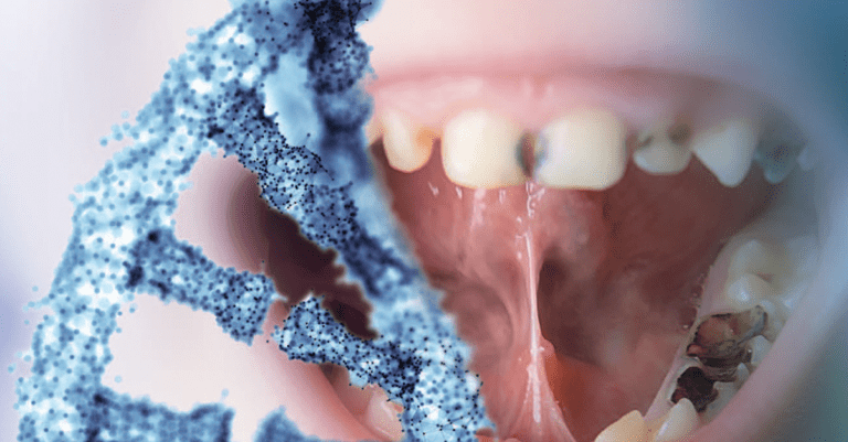 SNPs in Tooth Mineral Tissues Genes Linked to Dental Caries Trajectory_Dental Resource Asia