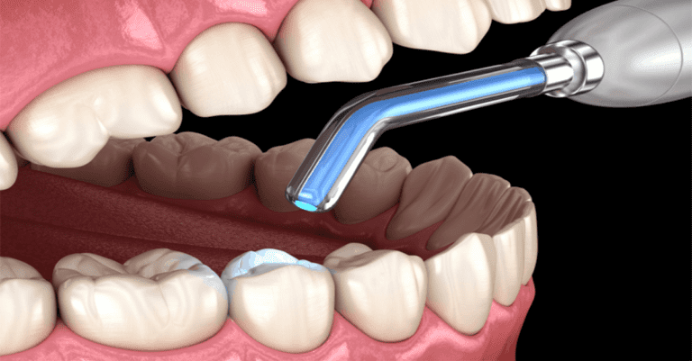 New ADA Guideline Recommends Conservative Treatment Methods for Tooth Decay_Dental Resource Asia