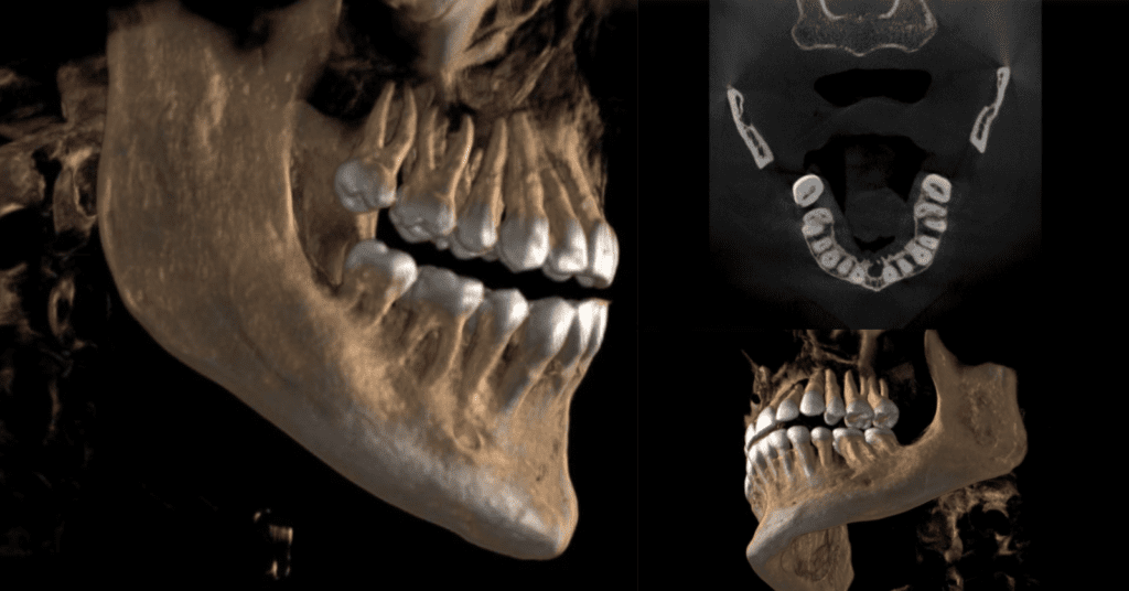 Factors Influencing Your Dental CBCT System Choice_1_Dental Resource Asia