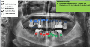 SayHeart and Kindlehouse Dentistry Collaborate for AI-Powered Dental X-Ray Transformation Pilot Testing_Dental Resource Asia