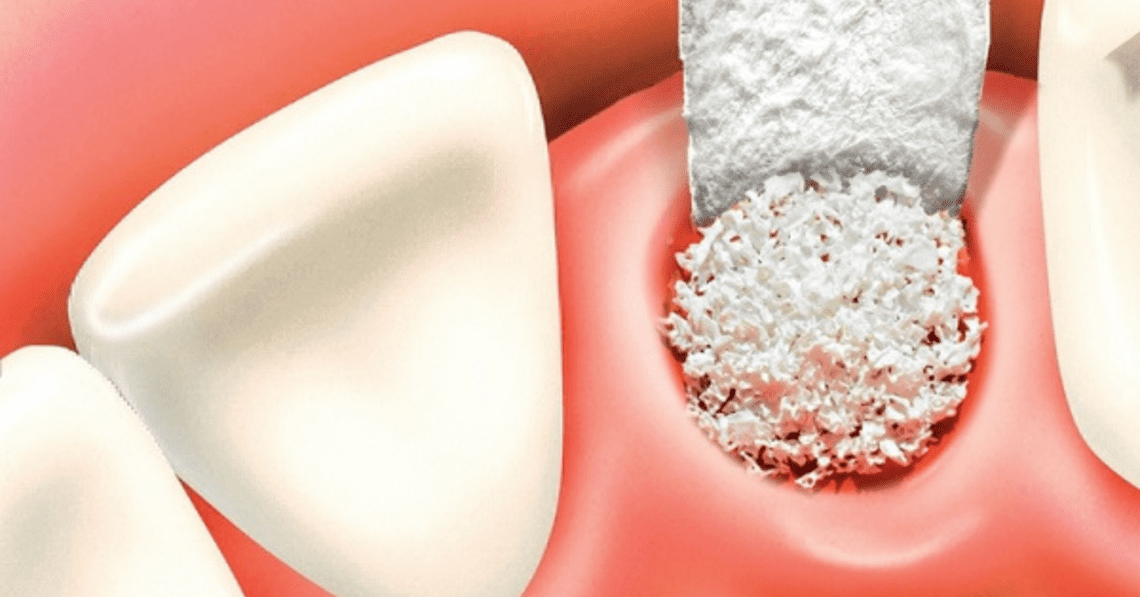 iData Research Unveils European Dental Bone Graft Substitutes Market