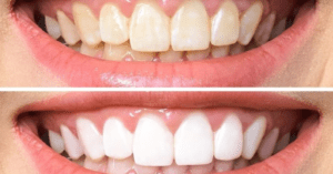 Teeth Whitening Market Expected to Grow by $1.16 Billion by 2027_Dental Resource Asia