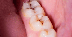 Natural Molecule DIM Shows Remarkable Potential in Dental Care_Dental Resource Asia