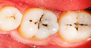 New Approach Offers Hope in Battle Against Dental Caries_Dental Resource Asia