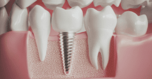 Review Finds Variability in Bacterial Colonisation on Dental Implants with Different Hygiene Instruments_Dental Resource Asia