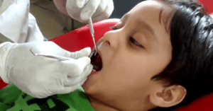 Indian Dentists Urge Caution in Root Canal Treatment for Children_Dental Resource Asia