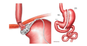 Obesity Surgery Linked to Increased Dental Caries Risk and Decline in Oral Health_Dental Resource Asia