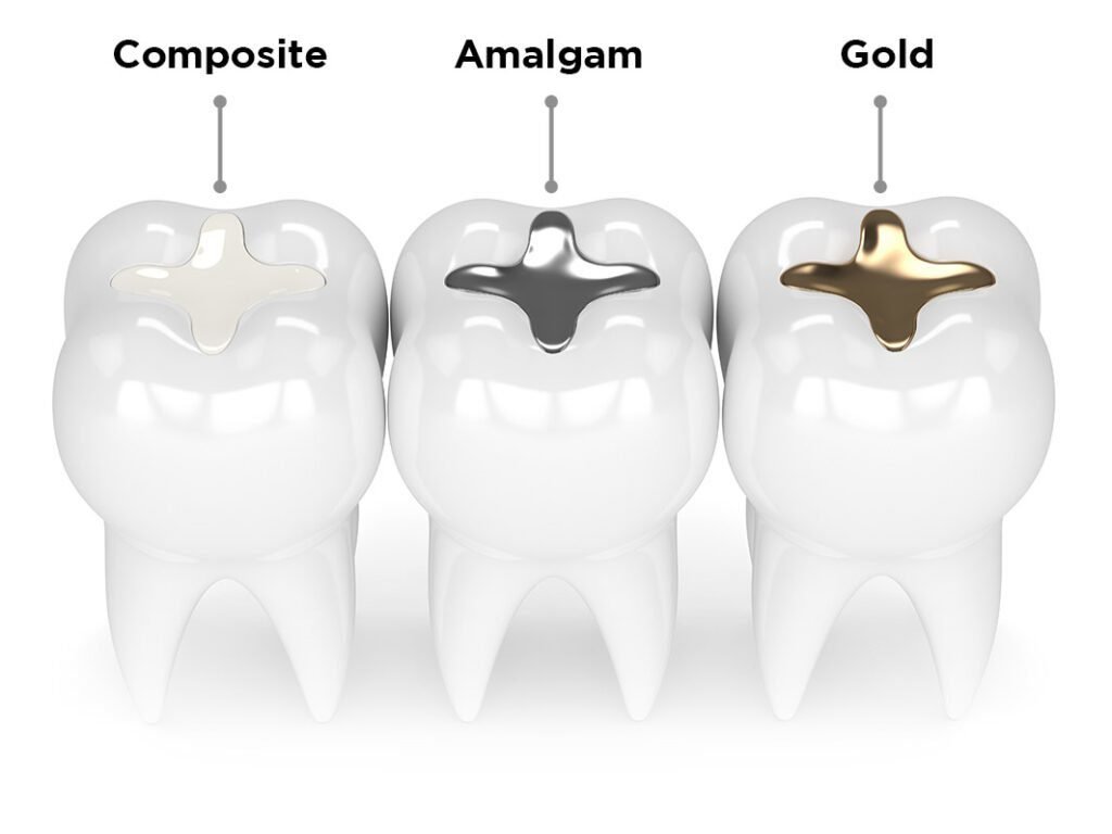 3d render of teeth with different types of dental filling