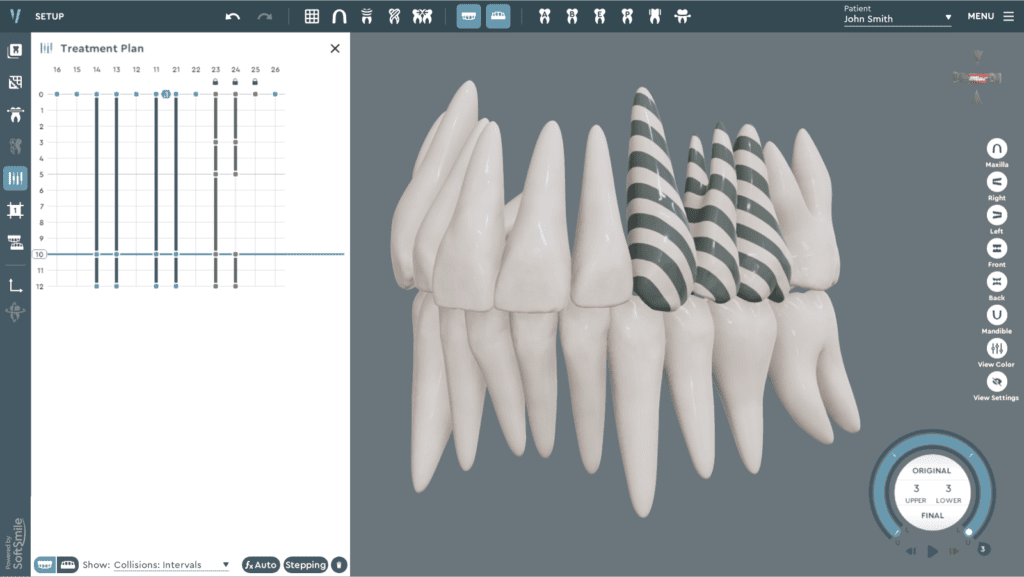 Softsmile VISION treatment planning software_Dental Resource Asia