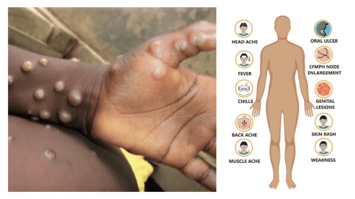 Monkeypox And The Dental Team